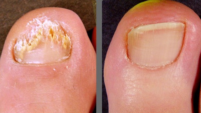 Claronail Fungal Nail Patches