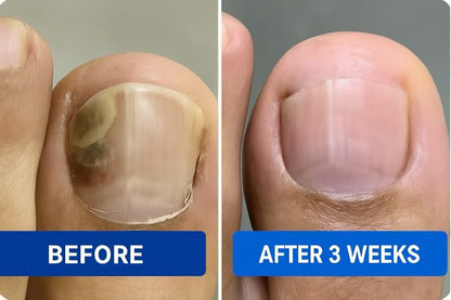 Claronail Fungal Nail Patches